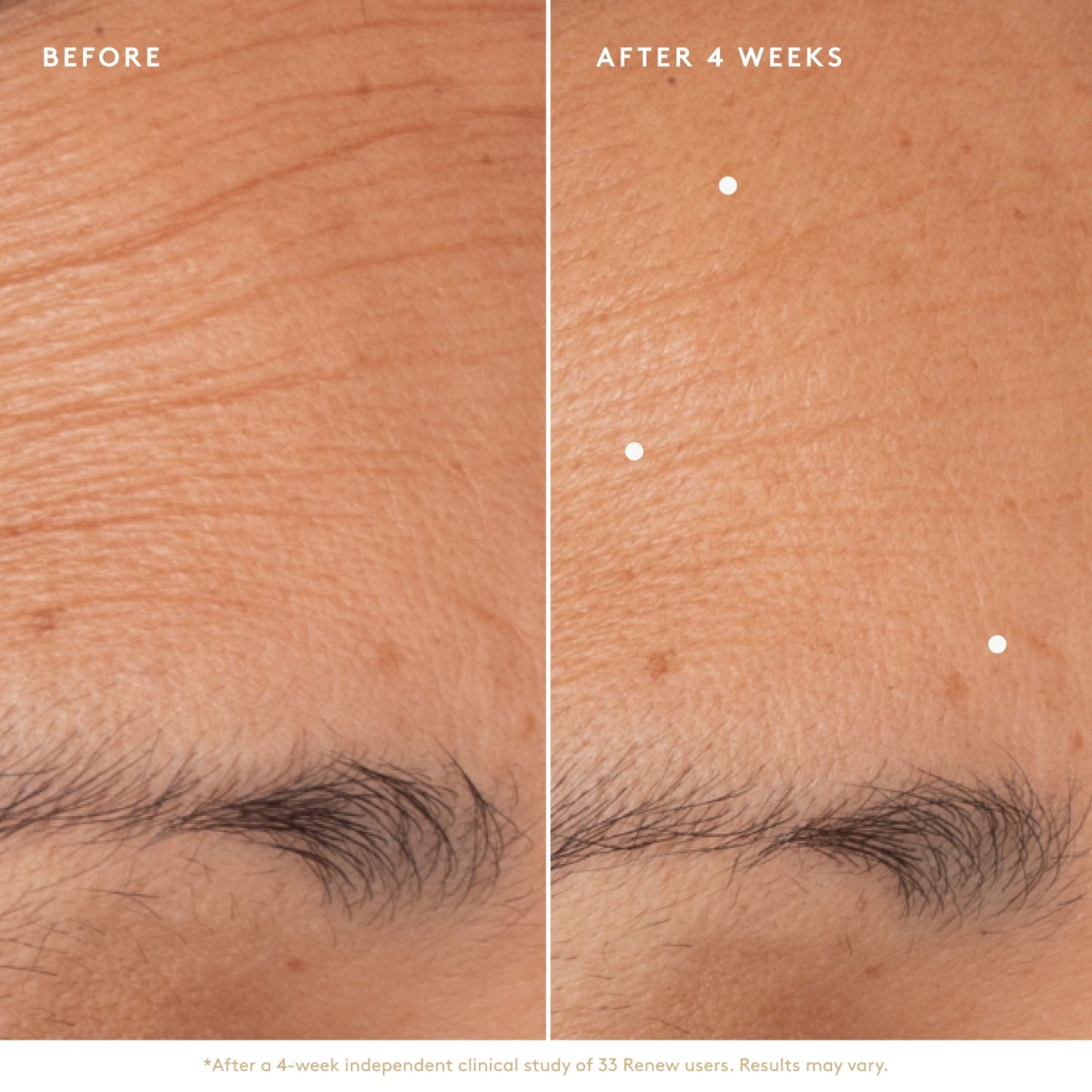 
                
                  Before and After Renew Resurfacing Night Serum
                
              